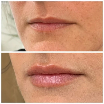 Lip Plumper for Fyldigere Lepper