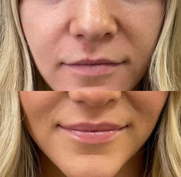 Lip Plumper for Fyldigere Lepper