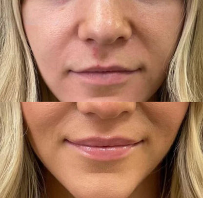Lip Plumper for Fyldigere Lepper