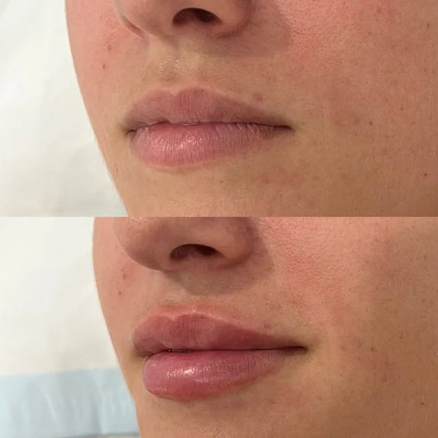 Lip Plumper for Fyldigere Lepper