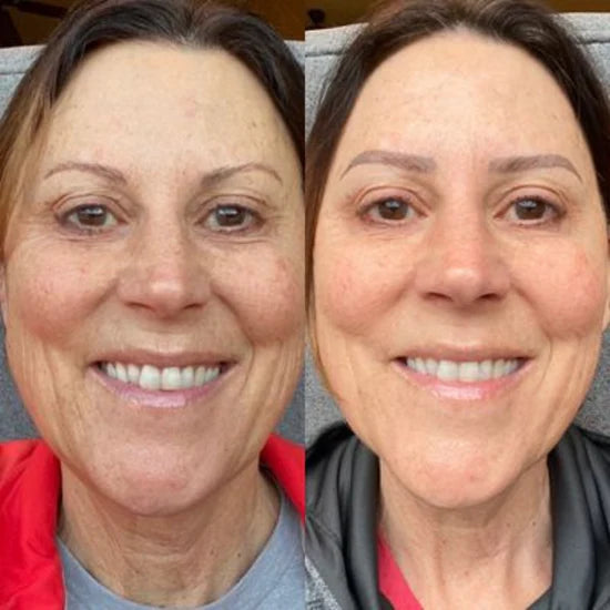 Plumping Serum mot Pigmentering og Mørke Flekker