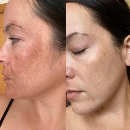 Plumping Serum mot Pigmentering og Mørke Flekker